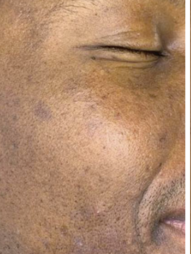 Before MOXI, skin texture and tone