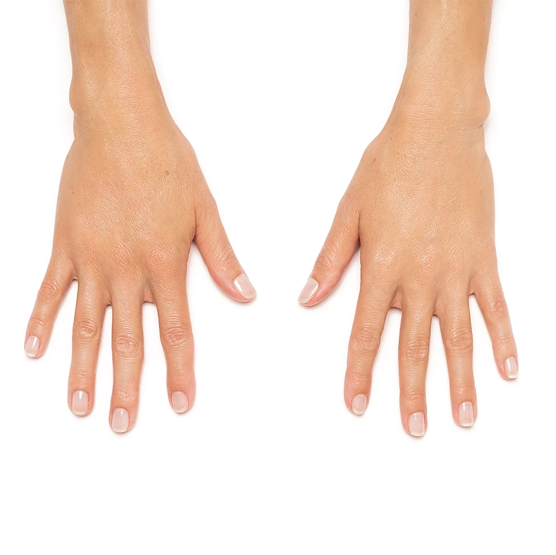 After Radiesse hand rejuvenation