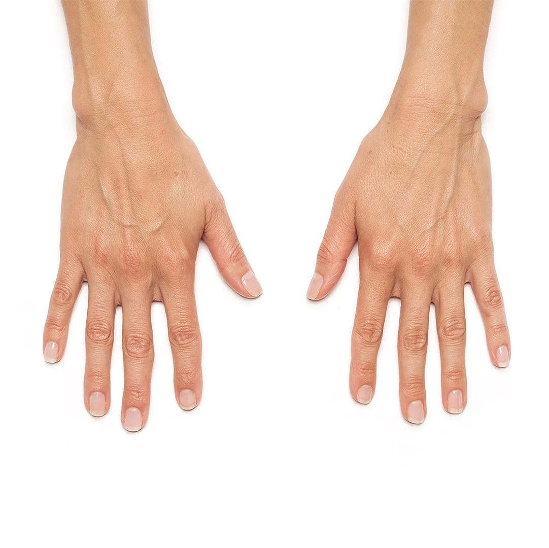 Before Radiesse hand rejuvenation