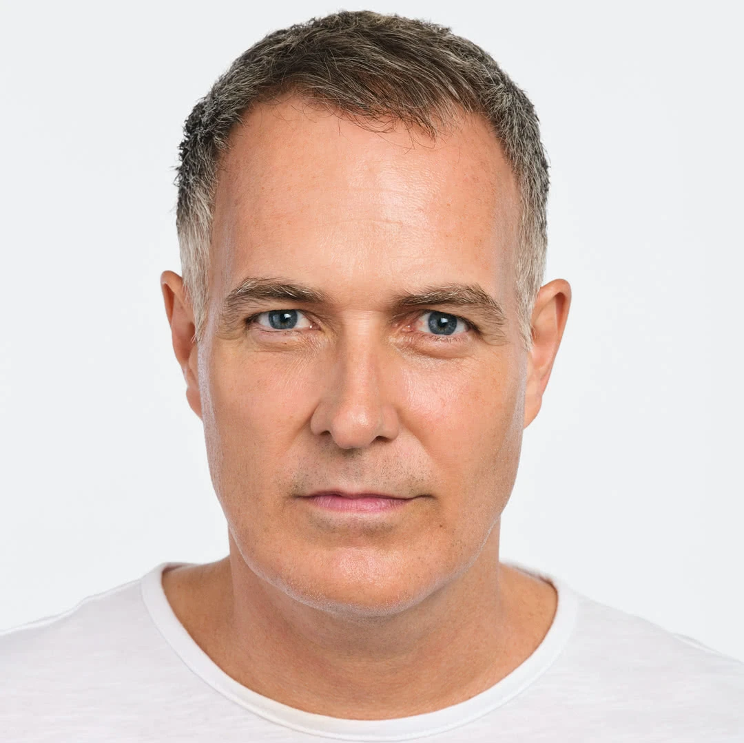 After Radiesse jawline contouring