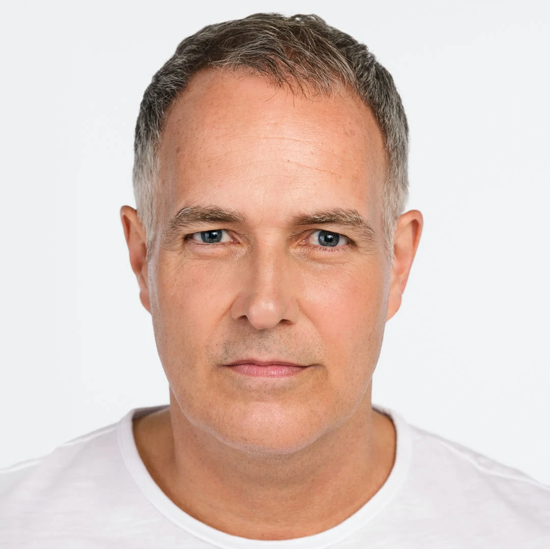 Before Radiesse jawline treatment