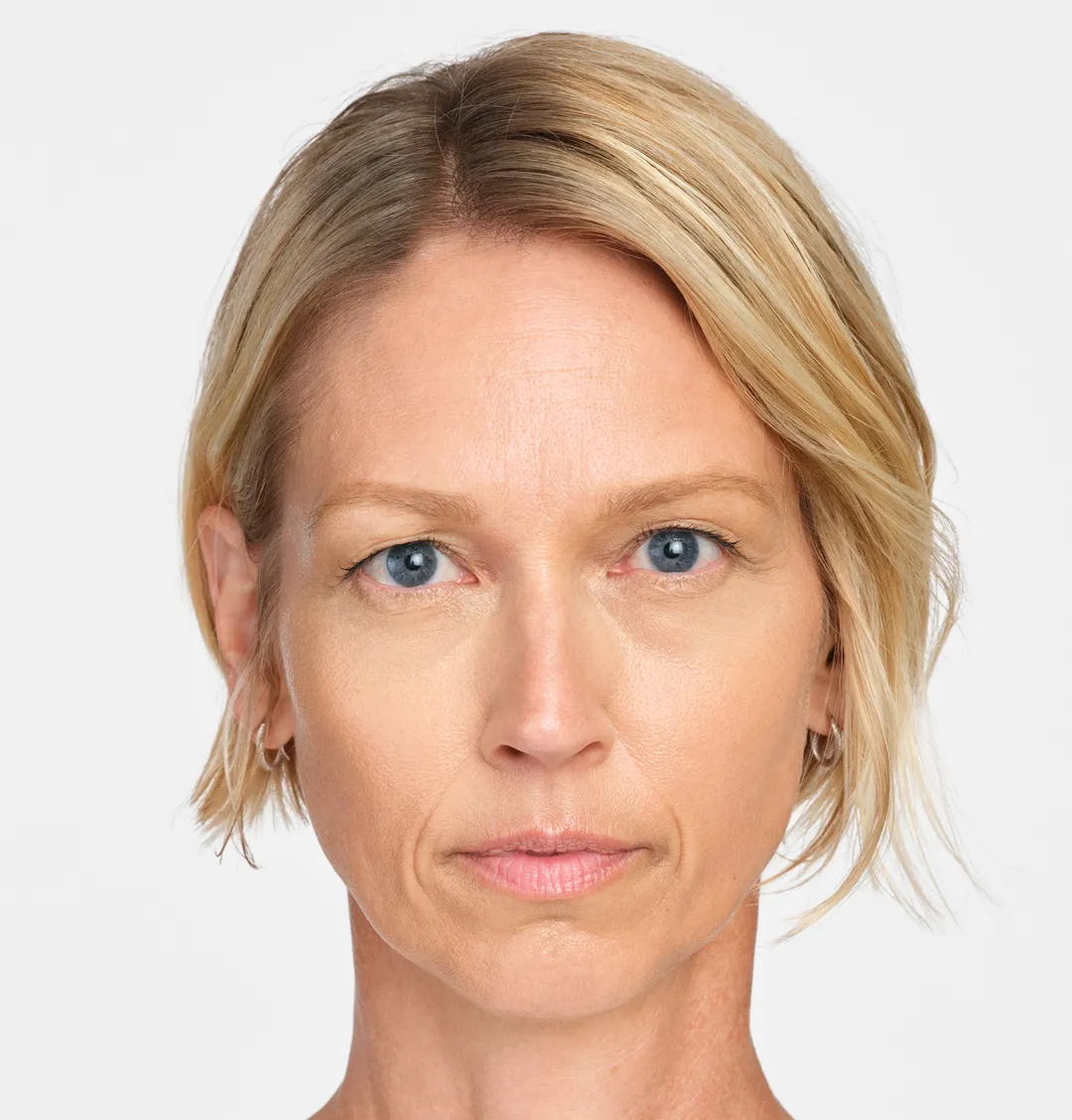 After Radiesse nasolabial folds