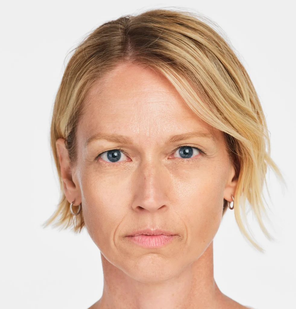 Before Radiesse nasolabial folds