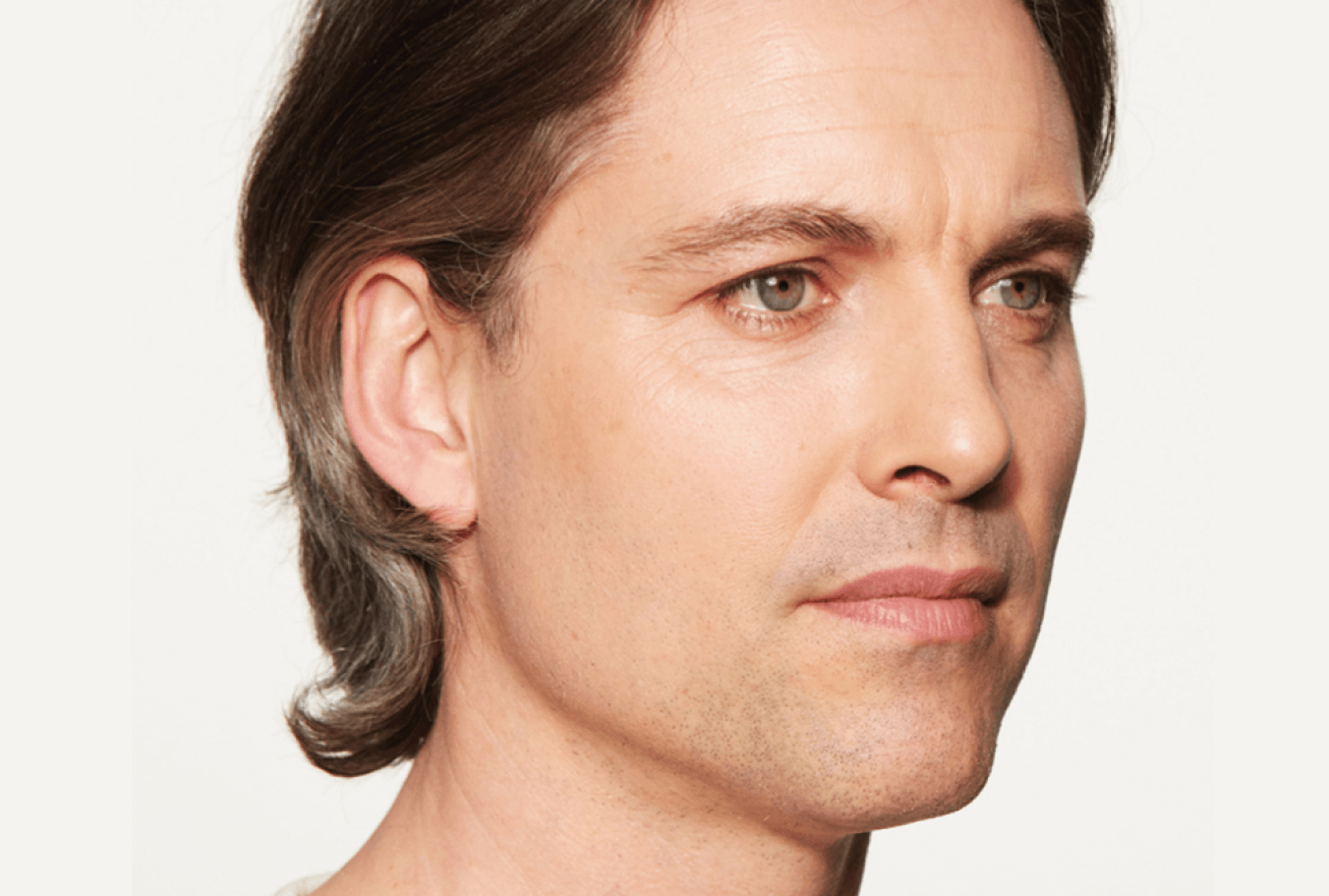 After Sculptra, restored collagen and midface volume