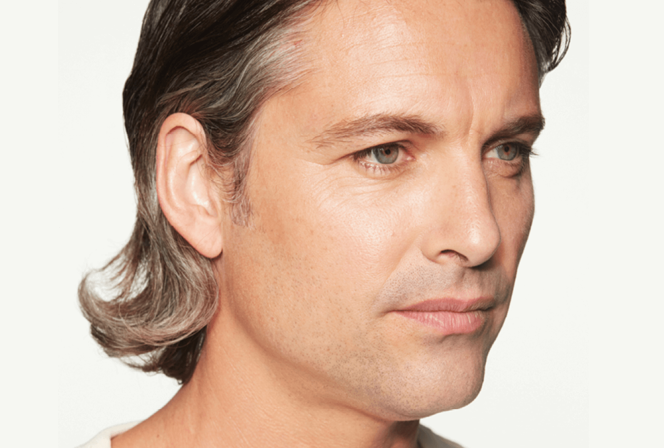 Before Sculptra, male facial volume loss